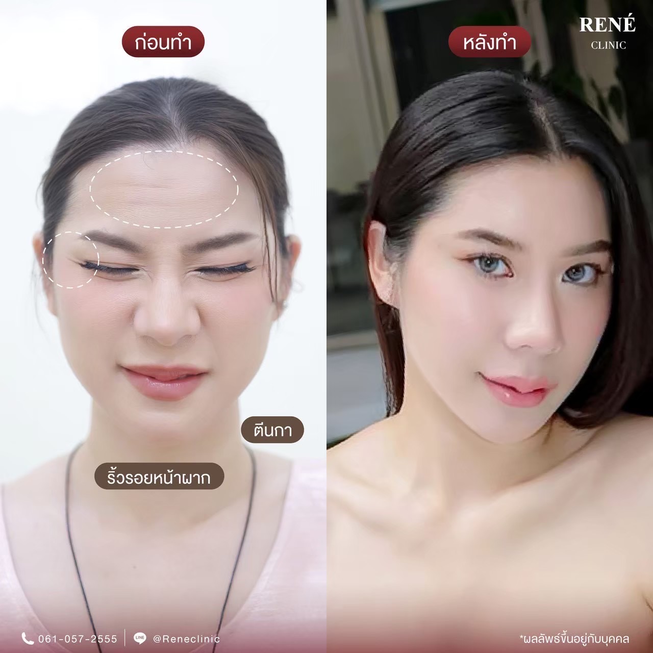รีวิว Botox #15