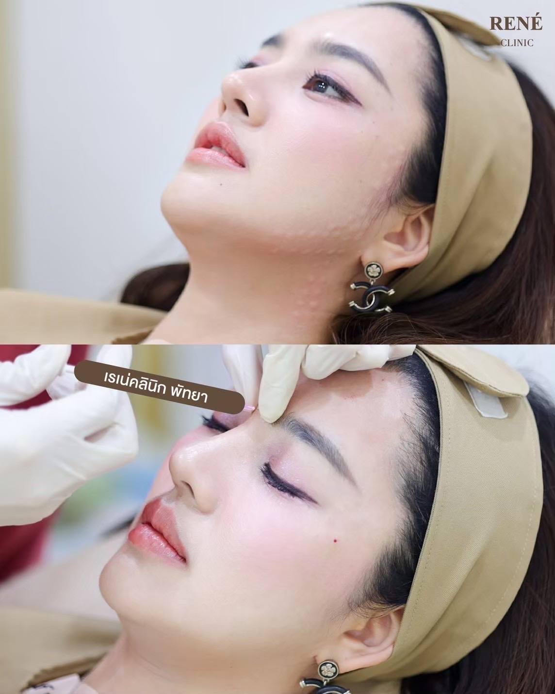 รีวิว Botox #19