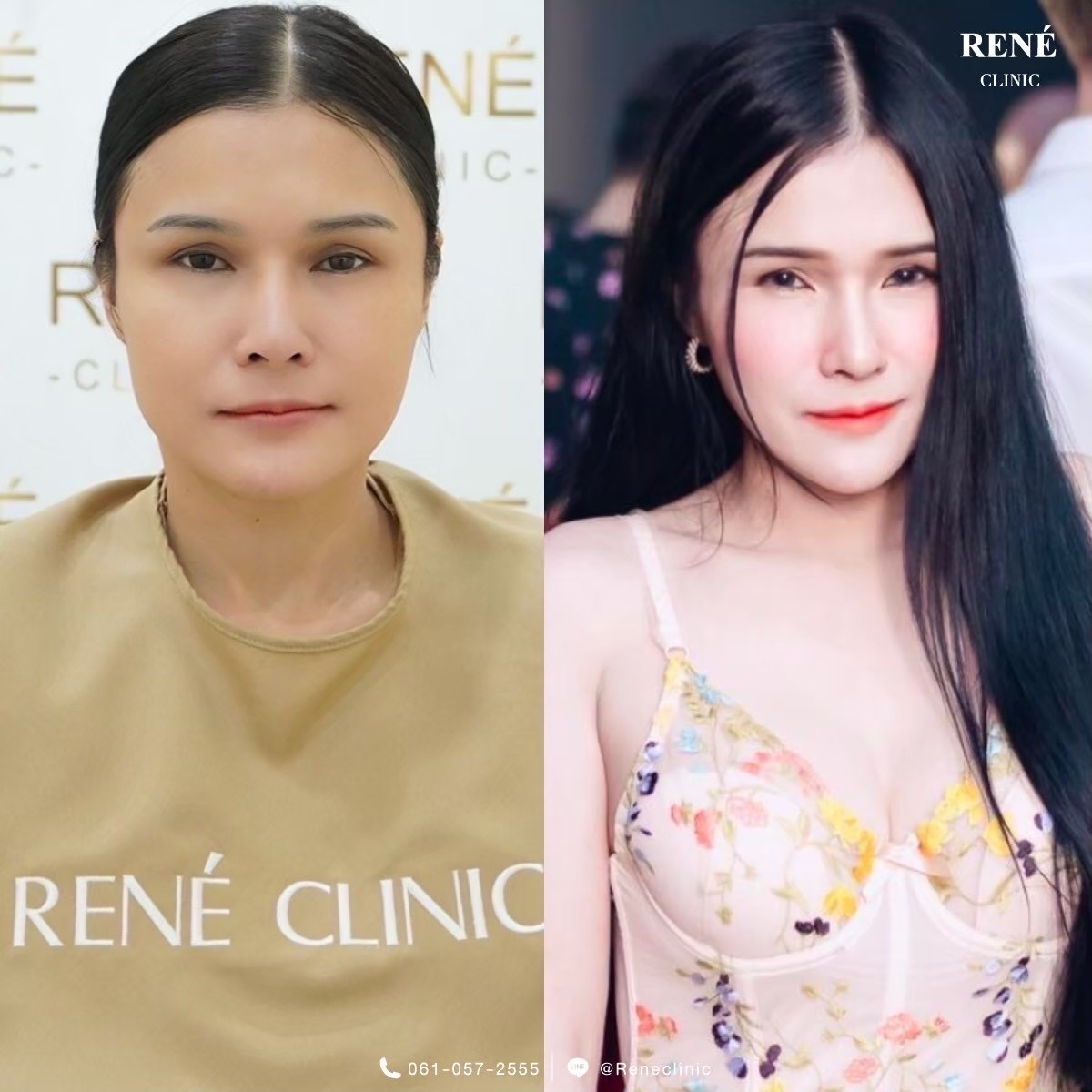 รีวิว Botox #2