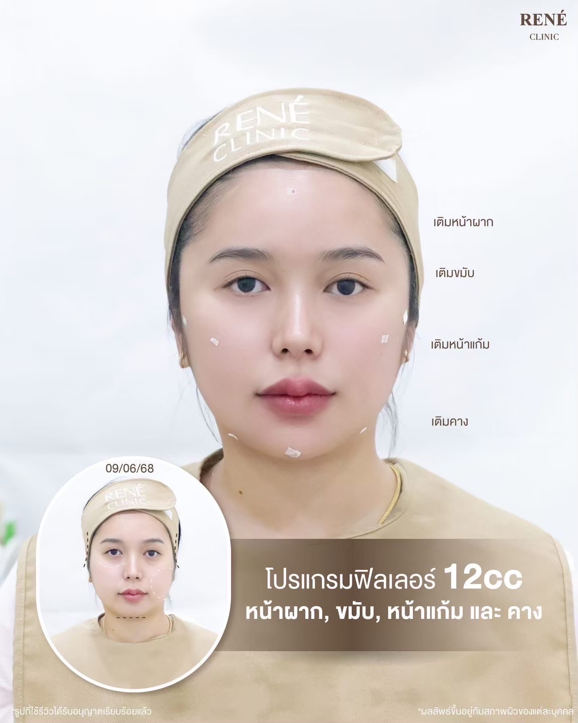 รีวิว Filler #2