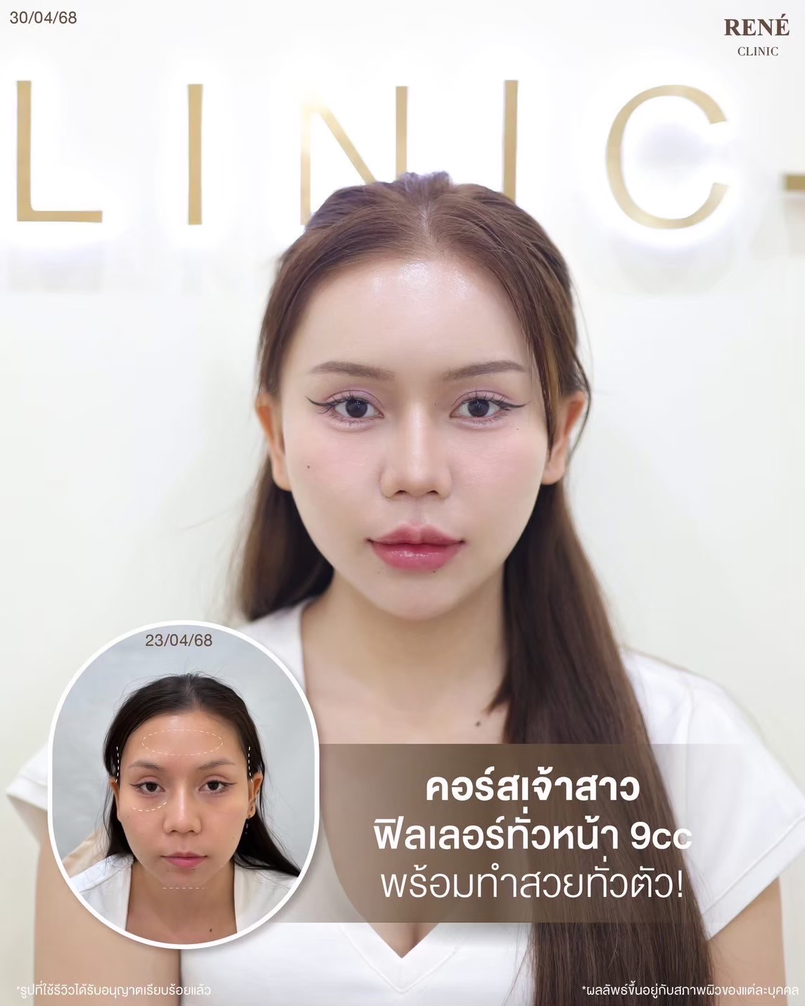 รีวิว Filler #3