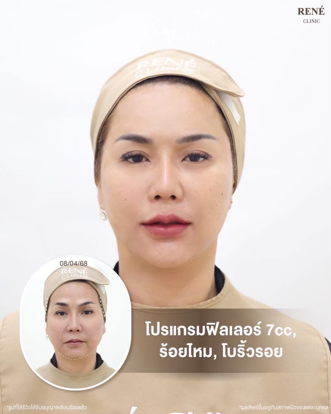 รีวิว Filler #5